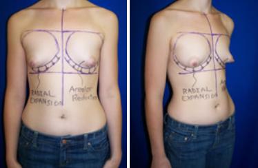 What do tubular breasts look like?