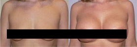 Breast Implants Photo Gallery