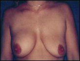 Breast Implant Rupture / Deflation Photo
