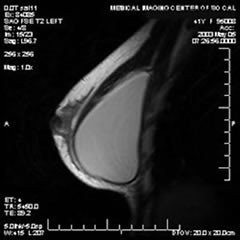 MRI of a gummy bear implant